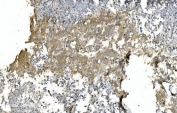 IHC staining of FFPE human pancreatic cancer with TUBA1 antibody. HIER: boil tissue sections in pH8 EDTA for 20 min and allow to cool before testing.