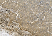 IHC staining of FFPE human lung cancer with TUBA1 antibody. HIER: boil tissue sections in pH8 EDTA for 20 min and allow to cool before testing.