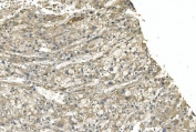 IHC staining of FFPE human liver cancer with TUBA1 antibody. HIER: boil tissue sections in pH8 EDTA for 20 min and allow to cool before testing.