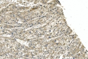 IHC staining of FFPE human liver cancer with TUBA1 antibody. HIER: boil tissue sections in pH8 EDTA for 20 min and allow to cool before testing.
