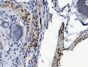 IHC staining of FFPE human rectal cancer with PTBP2 antibody. HIER: boil tissue sections in pH8 EDTA for 20 min and allow to cool before testing.