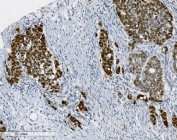 IHC staining of FFPE human gallbladder adenocarcinoma tissue with PTBP2 antibody. HIER: boil tissue sections in pH8 EDTA for 20 min and allow to cool before testing.