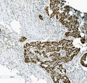 IHC staining of FFPE human gallbladder adenocarcinoma tissue with PTBP2 antibody. HIER: boil tissue sections in pH8 EDTA for 20 min and allow to cool before testing.
