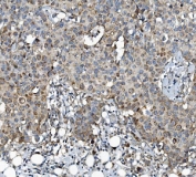 IHC staining of FFPE human breast cancer tissue with Argonaute 3 antibody. HIER: boil tissue sections in pH8 EDTA for 20 min and allow to cool before testing.