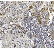 IHC staining of FFPE human lung cancer tissue with Argonaute 3 antibody. HIER: boil tissue sections in pH8 EDTA for 20 min and allow to cool before testing.
