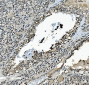 IHC staining of FFPE human renal clear cell carcinoma with MAP2K2 antibody. HIER: boil tissue sections in pH8 EDTA for 20 min and allow to cool before testing.