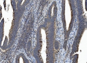 IHC staining of FFPE human rectal cancer with CASP7 antibody. HIER: boil tissue sections in pH8 EDTA for 20 min and allow to cool before testing.