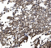 IHC staining of FFPE human lung cancer with TORC1/CRTC1 antibody. HIER: boil tissue sections in pH8 EDTA for 20 min and allow to cool before testing.