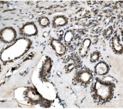 IHC staining of FFPE human breast cancer with VPRBP antibody. HIER: boil tissue sections in pH8 EDTA for 20 min and allow to cool before testing.