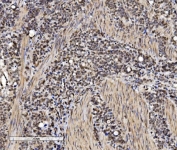 IHC staining of FFPE human gastric cancer with VPRBP antibody. HIER: boil tissue sections in pH8 EDTA for 20 min and allow to cool before testing.
