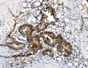IHC staining of FFPE human rectal cancer with VPRBP antibody. HIER: boil tissue sections in pH8 EDTA for 20 min and allow to cool before testing.