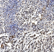 IHC staining of FFPE human pancreatic cancer with VPRBP antibody. HIER: boil tissue sections in pH8 EDTA for 20 min and allow to cool before testing.