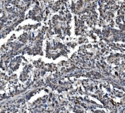 IHC staining of FFPE human ovarian adenocarcinoma with VPRBP antibody. HIER: boil tissue sections in pH8 EDTA for 20 min and allow to cool before testing.