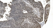 IHC staining of FFPE human ovarian serous adenocarcinoma with hnRNP H3 antibody. HIER: boil tissue sections in pH8 EDTA for 20 min and allow to cool before testing.
