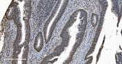 IHC staining of FFPE human rectal cancer with hnRNP H3 antibody. HIER: boil tissue sections in pH8 EDTA for 20 min and allow to cool before testing.