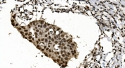 IHC staining of FFPE human breast cancer with hnRNP H3 antibody. HIER: boil tissue sections in pH8 EDTA for 20 min and allow to cool before testing.