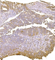 IHC staining of FFPE human ovarian serous adenocarcinoma tissue with LY6E antibody. HIER: boil tissue sections in pH8 EDTA for 20 min and allow to cool before testing.