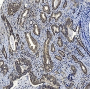 IHC staining of FFPE human gallbladder adenocarcinoma with SMAD2 antibody. HIER: boil tissue sections in pH8 EDTA for 20 min and allow to cool before testing.