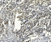 IHC staining of FFPE human pancreatic cancer with SMAD2 antibody. HIER: boil tissue sections in pH8 EDTA for 20 min and allow to cool before testing.