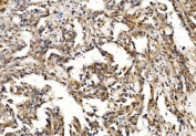 IHC staining of FFPE human renal cancer with PFN2 antibody. HIER: boil tissue sections in pH8 EDTA for 20 min and allow to cool before testing.