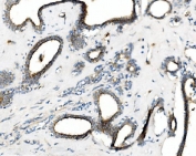 IHC staining of FFPE human breast cancer with PRKG1 antibody. HIER: boil tissue sections in pH8 EDTA for 20 min and allow to cool before testing.