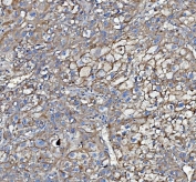 IHC staining of FFPE human liver cancer with Poliovirus Receptor antibody. HIER: boil tissue sections in pH8 EDTA for 20 min and allow to cool before testing.