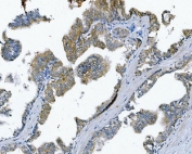 IHC staining of FFPE human prostate cancer with Poliovirus Receptor antibody. HIER: boil tissue sections in pH8 EDTA for 20 min and allow to cool before testing.