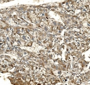 IHC staining of FFPE human liver cancer tissue with Synaptic vesicle glycoprotein 2A antibody. HIER: boil tissue sections in pH8 EDTA for 20 min and allow to cool before testing.