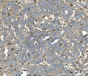 IHC staining of FFPE human ovarian serous adenocarcinoma with Synaptic vesicle glycoprotein 2A antibody. HIER: boil tissue sections in pH8 EDTA for 20 min and allow to cool before testing.