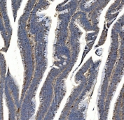 IHC staining of FFPE human rectal cancer with Synaptic vesicle glycoprotein 2A antibody. HIER: boil tissue sections in pH8 EDTA for 20 min and allow to cool before testing.