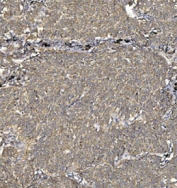 IHC staining of FFPE human lung cancer tissue with Synaptic vesicle glycoprotein 2A antibody. HIER: boil tissue sections in pH8 EDTA for 20 min and allow to cool before testing.