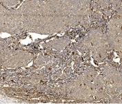 IHC staining of FFPE human lung cancer with Wolframin antibody. HIER: boil tissue sections in pH8 EDTA for 20 min and allow to cool before testing.