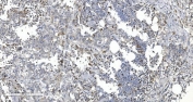IHC staining of FFPE human pancreatic cancer tissue with ARG2 antibody. HIER: boil tissue sections in pH8 EDTA for 20 min and allow to cool before testing.