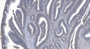 IHC staining of FFPE human rectal cancer tissue with ARG2 antibody. HIER: boil tissue sections in pH8 EDTA for 20 min and allow to cool before testing.