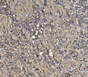 IHC staining of FFPE human gastric cancer with ATG9A antibody. HIER: boil tissue sections in pH8 EDTA for 20 min and allow to cool before testing.