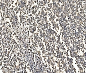 IHC staining of FFPE human pancreatic cancer with ATG9A antibody. HIER: boil tissue sections in pH8 EDTA for 20 min and allow to cool before testing.