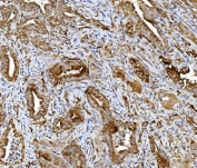 IHC staining of FFPE human gallbladder adenocarcinoma tissue with PDIR antibody. HIER: boil tissue sections in pH8 EDTA for 20 min and allow to cool before testing.
