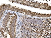 IHC staining of FFPE human rectal cancer tissue with PDIR antibody. HIER: boil tissue sections in pH8 EDTA for 20 min and allow to cool before testing.