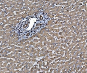 IHC staining of FFPE human liver cancer with ERp5 antibody. HIER: boil tissue sections in pH8 EDTA for 20 min and allow to cool before testing.