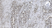 IHC staining of FFPE human gastric adenocarcinoma tissue with SAMHD1 antibody. HIER: boil tissue sections in pH8 EDTA for 20 min and allow to cool before testing.