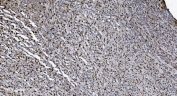 IHC staining of FFPE human lymphoma tissue with SAMHD1 antibody. HIER: boil tissue sections in pH8 EDTA for 20 min and allow to cool before testing.