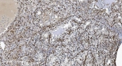 IHC staining of FFPE human renal clear cell carcinoma tissue with SAMHD1 antibody. HIER: boil tissue sections in pH8 EDTA for 20 min and allow to cool before testing.