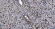 IHC staining of FFPE human gallbladder adenocarcinoma tissue with SAMHD1 antibody. HIER: boil tissue sections in pH8 EDTA for 20 min and allow to cool before testing.