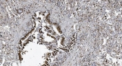 IHC staining of FFPE human lung cancer tissue with SAMHD1 antibody. HIER: boil tissue sections in pH8 EDTA for 20 min and allow to cool before testing.