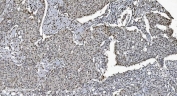 IHC staining of FFPE human breast cancer tissue with SAMHD1 antibody. HIER: boil tissue sections in pH8 EDTA for 20 min and allow to cool before testing.