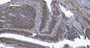 IHC staining of FFPE human rectal cancer tissue with SAMHD1 antibody. HIER: boil tissue sections in pH8 EDTA for 20 min and allow to cool before testing.