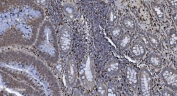 IHC staining of FFPE human rectal cancer tissue with SAMHD1 antibody. HIER: boil tissue sections in pH8 EDTA for 20 min and allow to cool before testing.