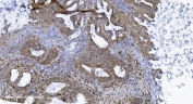 IHC staining of FFPE human ovarian cancer tissue with SAMHD1 antibody. HIER: boil tissue sections in pH8 EDTA for 20 min and allow to cool before testing.