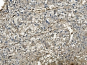 IHC staining of FFPE human liver cancer with PNP antibody. HIER: boil tissue sections in pH8 EDTA for 20 min and allow to cool before testing.