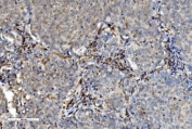 IHC staining of FFPE human lung cancer with PNP antibody. HIER: boil tissue sections in pH8 EDTA for 20 min and allow to cool before testing.